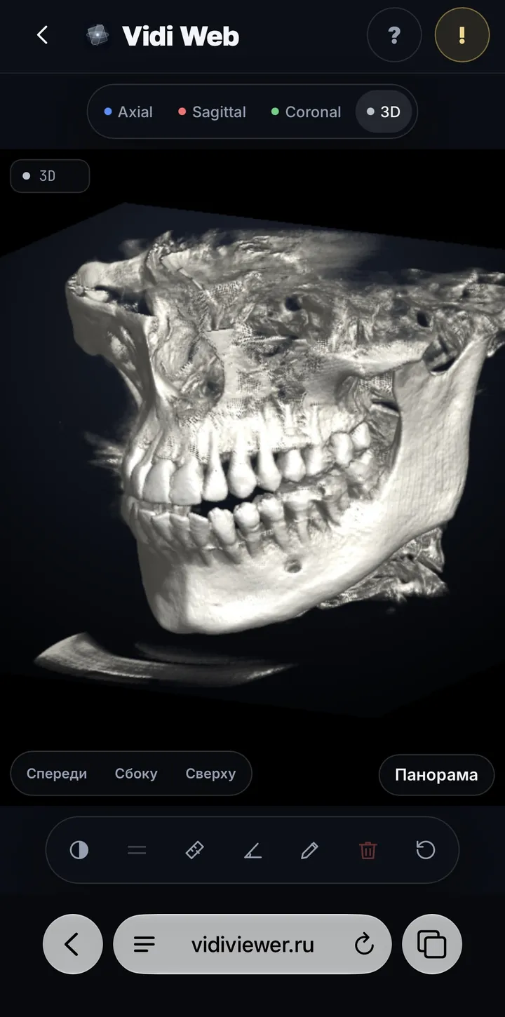 Vidi Web на iPhone: объёмная 3D-реконструкция черепа